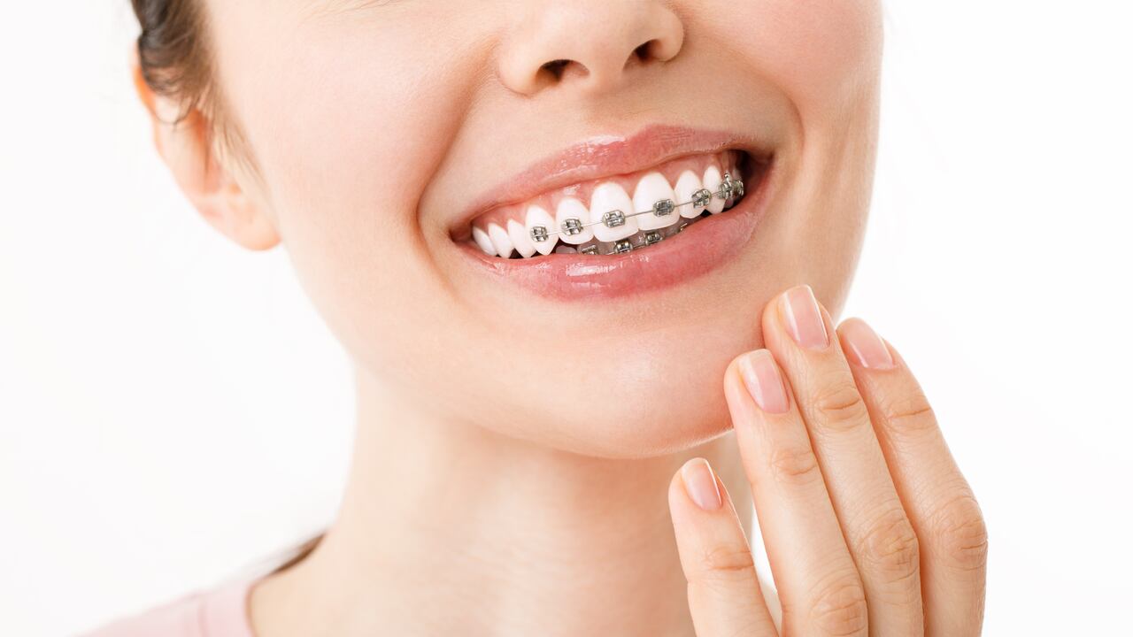 ¿Cómo hacer la higiene de los brackets?