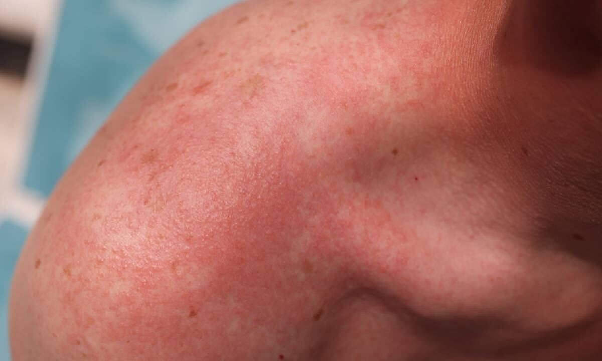 Alerta por creciente número de contagios de viruela del simio en Europa