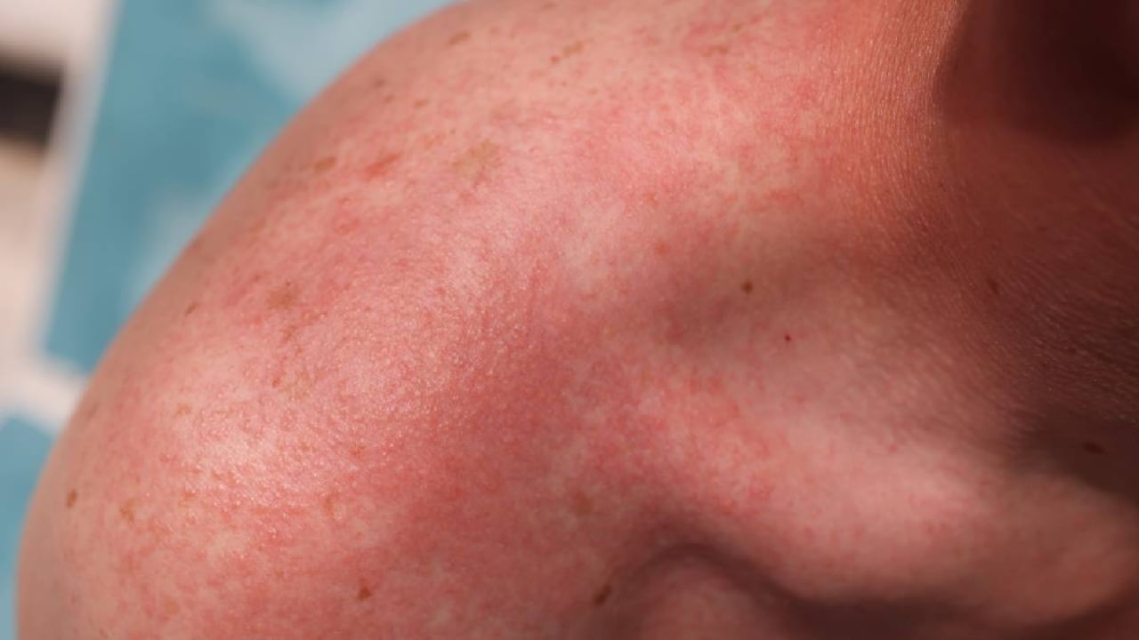 Alerta por creciente número de contagios de viruela del simio en Europa