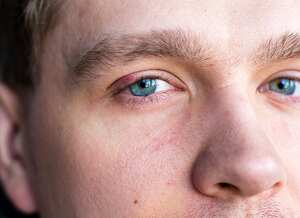 Selective focus on swollen and painful red upper eye lid with onset of stye infection due to clogged oil gland and staphylococcal bacteria.