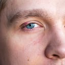 Selective focus on swollen and painful red upper eye lid with onset of stye infection due to clogged oil gland and staphylococcal bacteria.