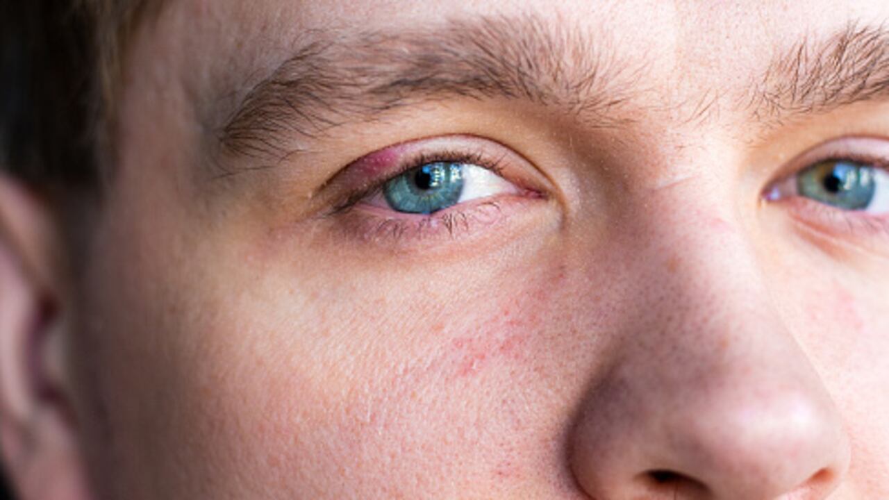 Existen distintos remedios caseros que ayudan a disminuir la inflamación de los párpados.