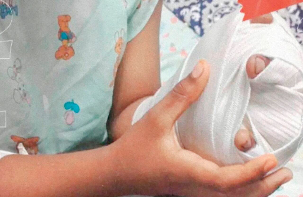 Quemaduras con pólvora 