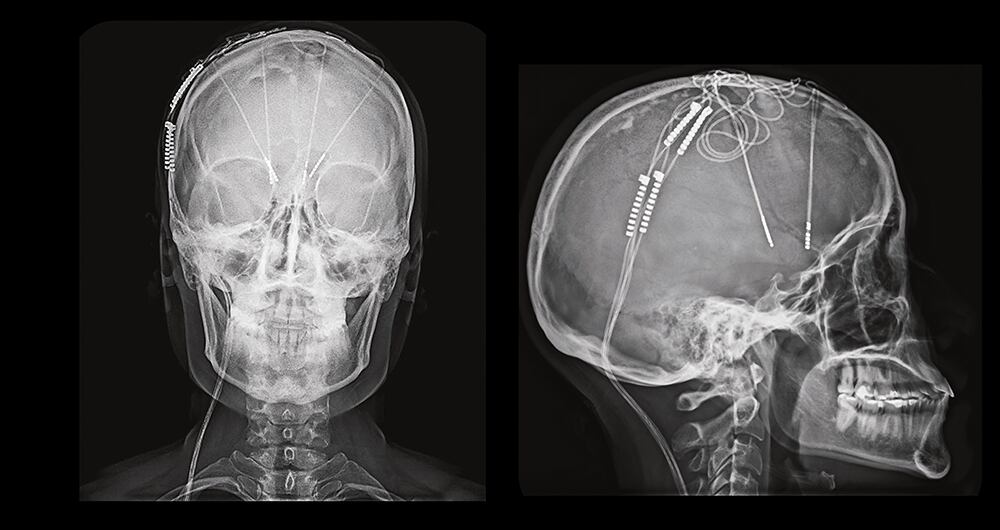 Marcapaso cerebral de cuatro puertos utilizado en la cirugía de estimulación cerebral profunda.