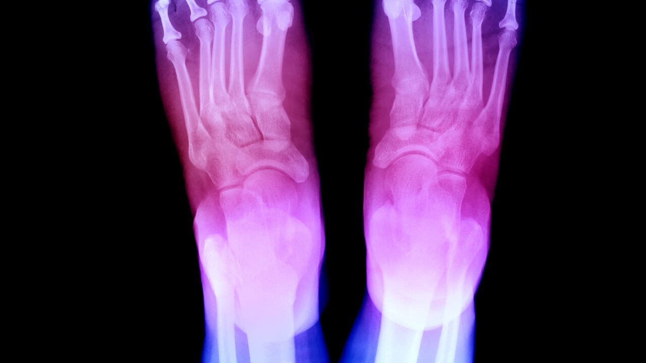 La mala circulación se puede presentar cuando hay enfermedades de base como el colesterol y la presión arterial.