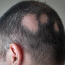 Alopecia areata