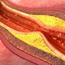 Cuando se acumula colesterol en las arterias incrementa el riesgo de enfermedades cardíacas.