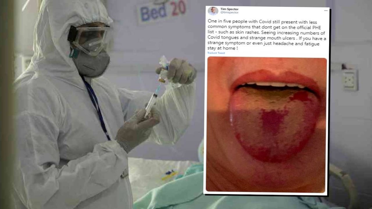 “Lengua covid”: ¿un nuevo síntoma de pacientes con coronavirus?