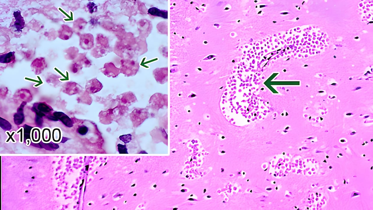 Las infecciones cerebrales que causa son muy raras, pero casi siempre mortales. Imagen de referencia