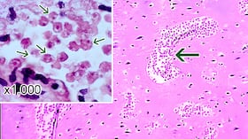 Las infecciones cerebrales que causa son muy raras, pero casi siempre mortales. Imagen de referencia