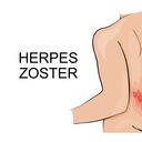 Infección por herpes zóster - Imagen de referencia