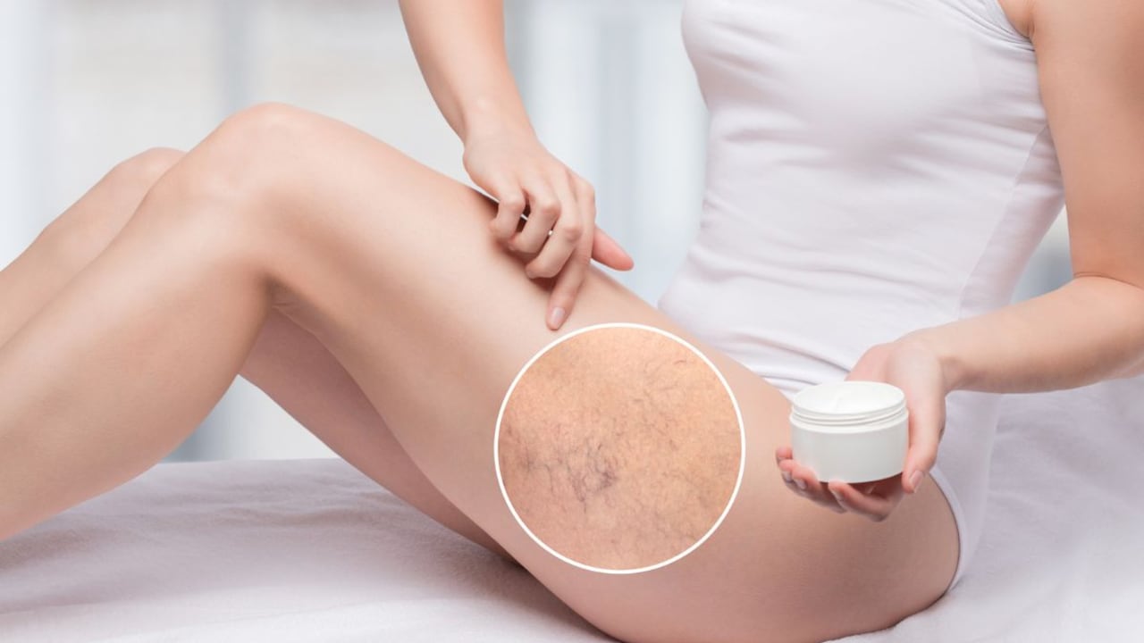 Vitaminas para las várices.