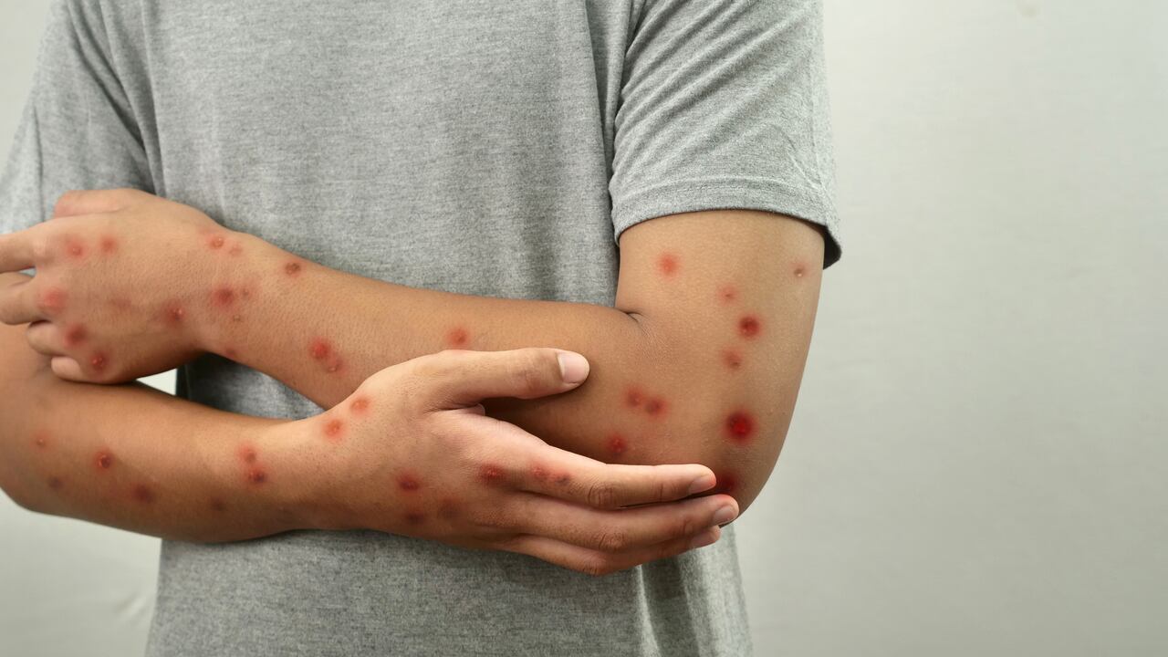 Persona anónima con viruela simica, concepto de epidemia de viruela simica