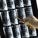 La falta de calcio puede producir osteoporosis. Foto: Getty Images