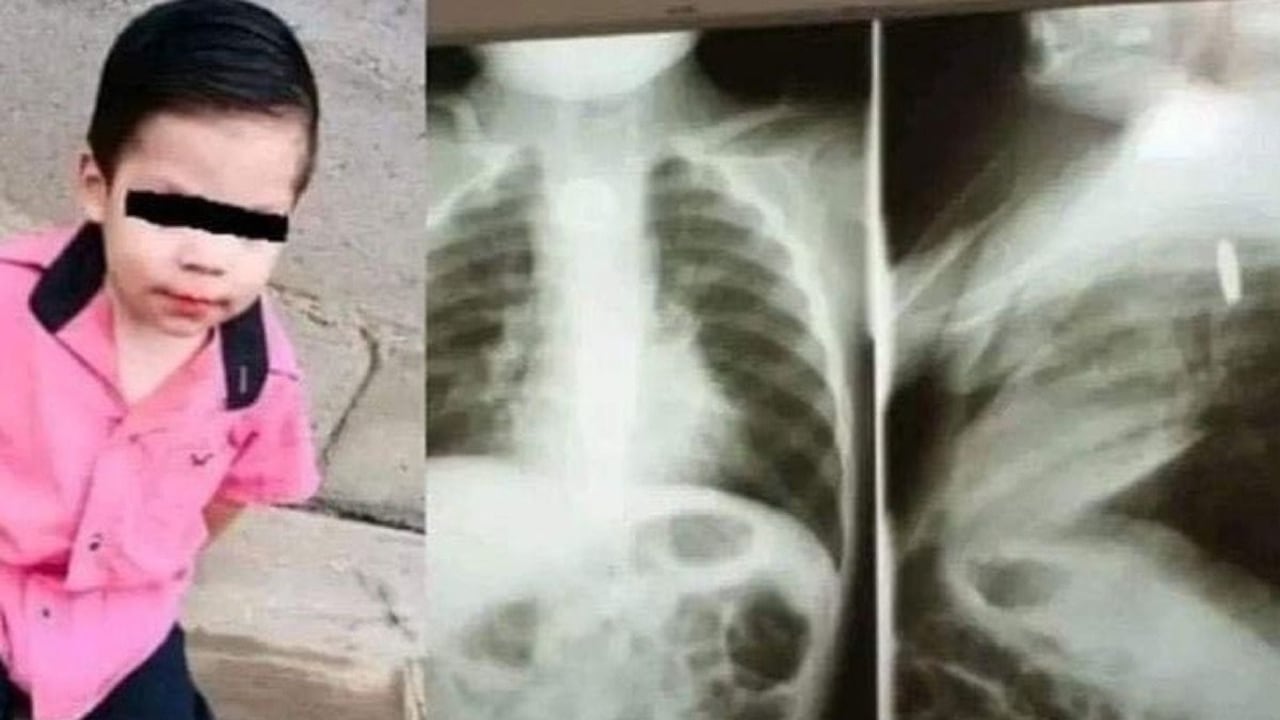 Lamentablemente, la situación se agravó luego de que el objeto explotara dentro de su cuerpo.