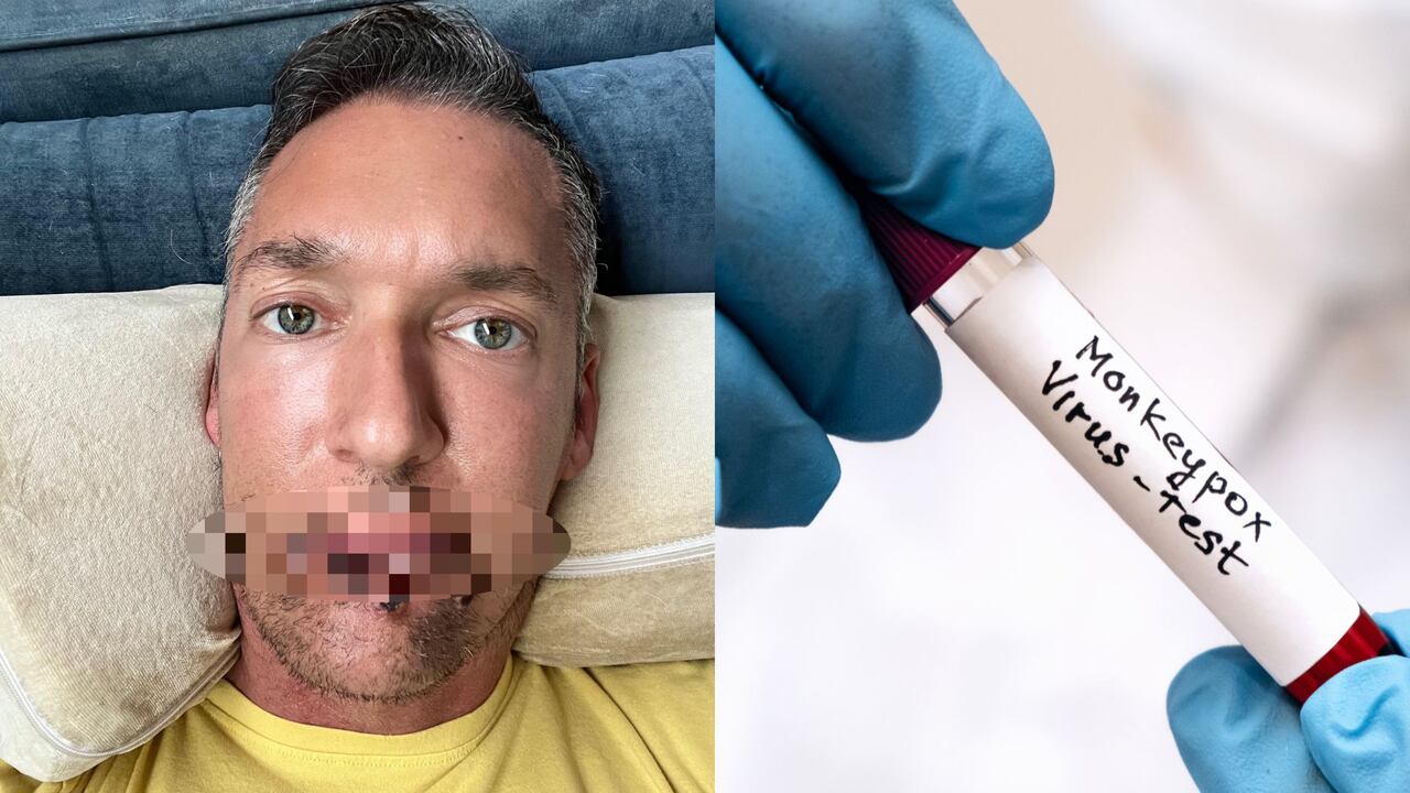 El actor de películas para adultos Silver Steele expuso las lesiones que le ha causado la ciruela del mono.