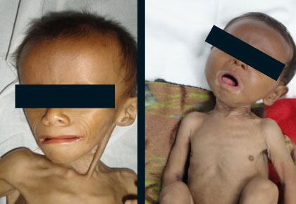 These are some of the children who have recently come to Puerto Gaitán hospital. The images reveal the devastating effects of hunger. All children from 3 to 5 years should weigh from 40 to 50 pounds, the stunted children in this town come to the medical center weighing from eleven to seventeen pounds.  