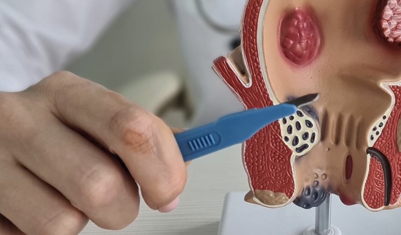 Las hemorroides causan en ocasiones fuertes dolores en quienes las padecen