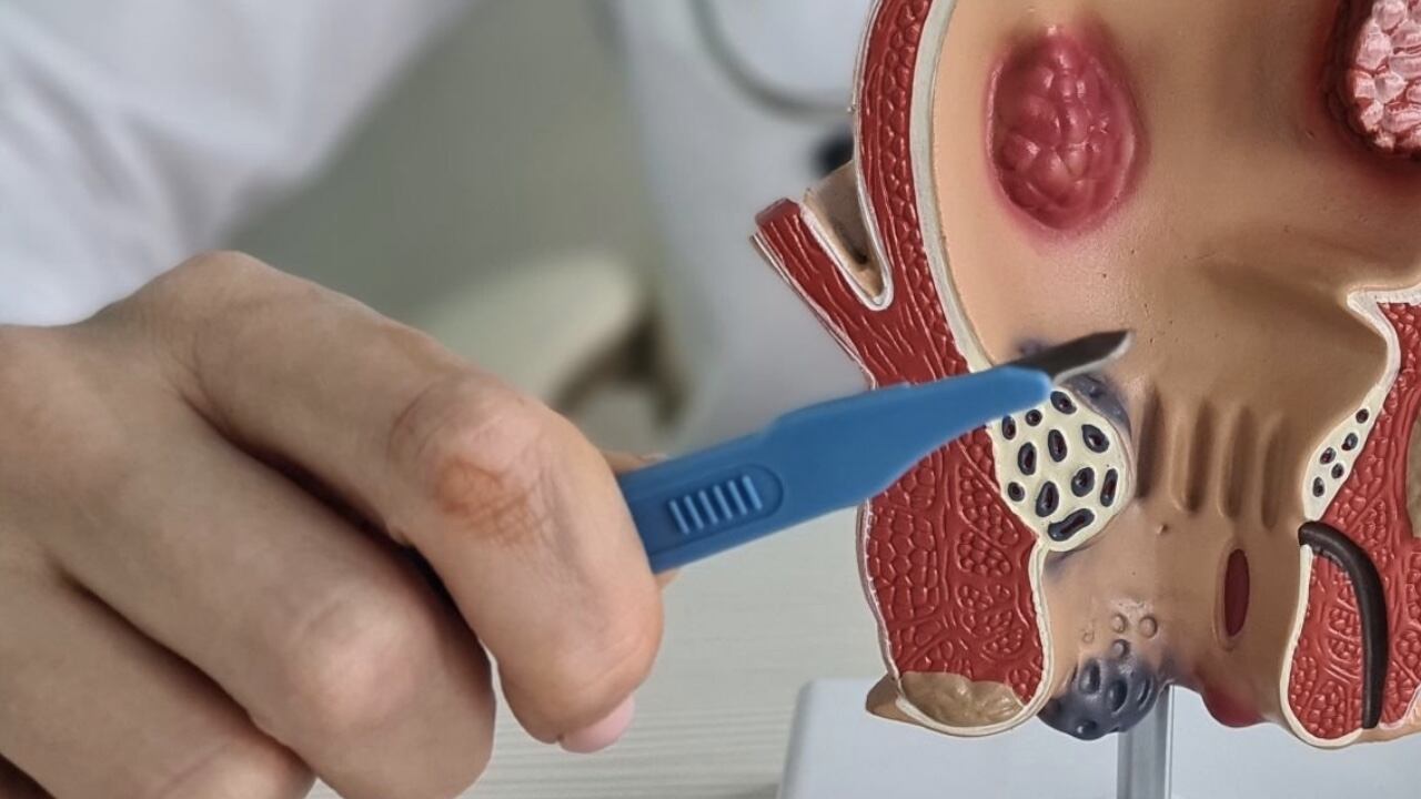 Las hemorroides causan en ocasiones fuertes dolores en quienes las padecen.