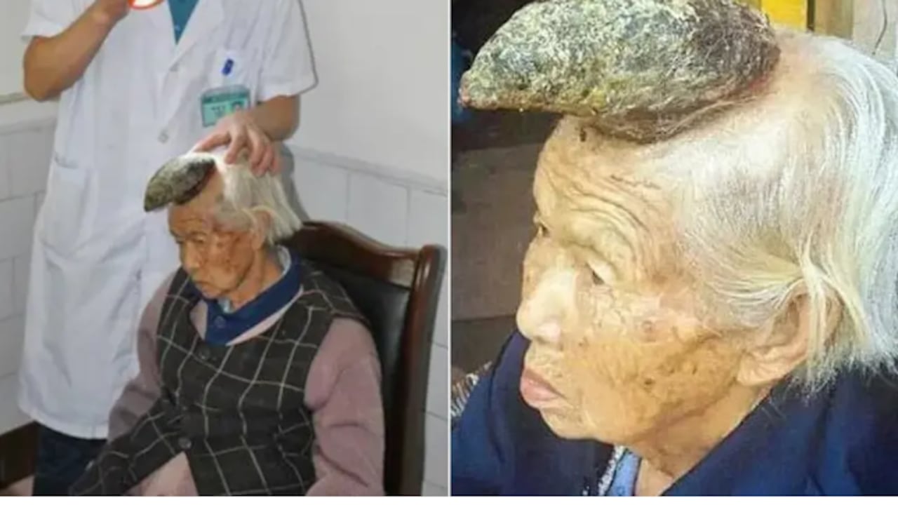 El extraño caso de la “abuela unicornio”: a una mujer en China le creció un cuerno de trece centímetros en la cabeza