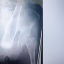 Un hombre en Venezuela de 79 años, llegó con una botella de vidrio atascada en el ano, según dijo unos ladrones se la introdujeron.