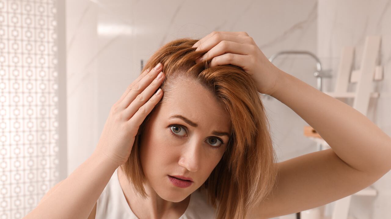 La alopecia androgénica es la pérdida de pelo a causa de factores genéticos.