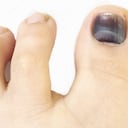 En ciertos casos, la banda negra puede aumentar su grosor y extenderse por toda la uña.