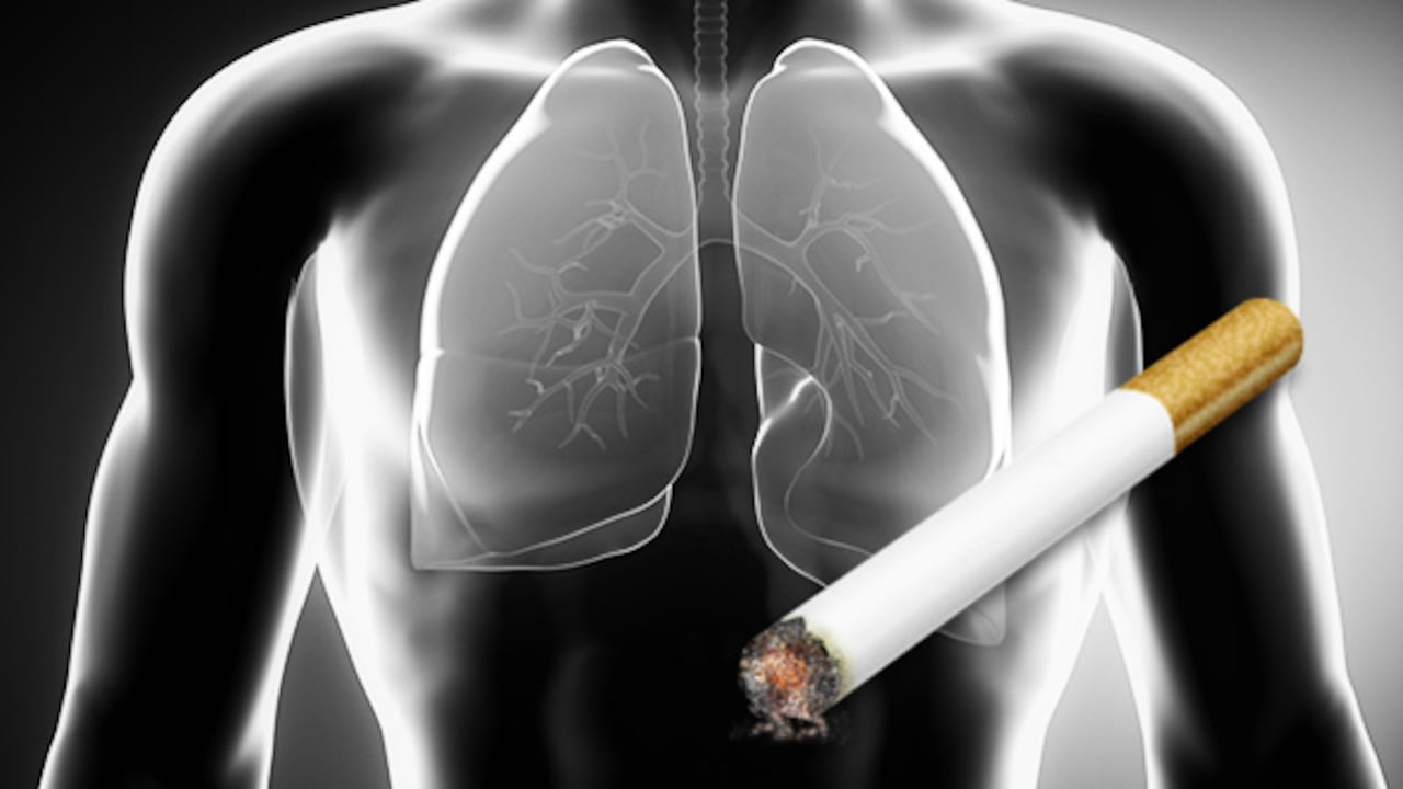 El cáncer de pulmón es la principal causa de muerte por cáncer en todo el mundo.