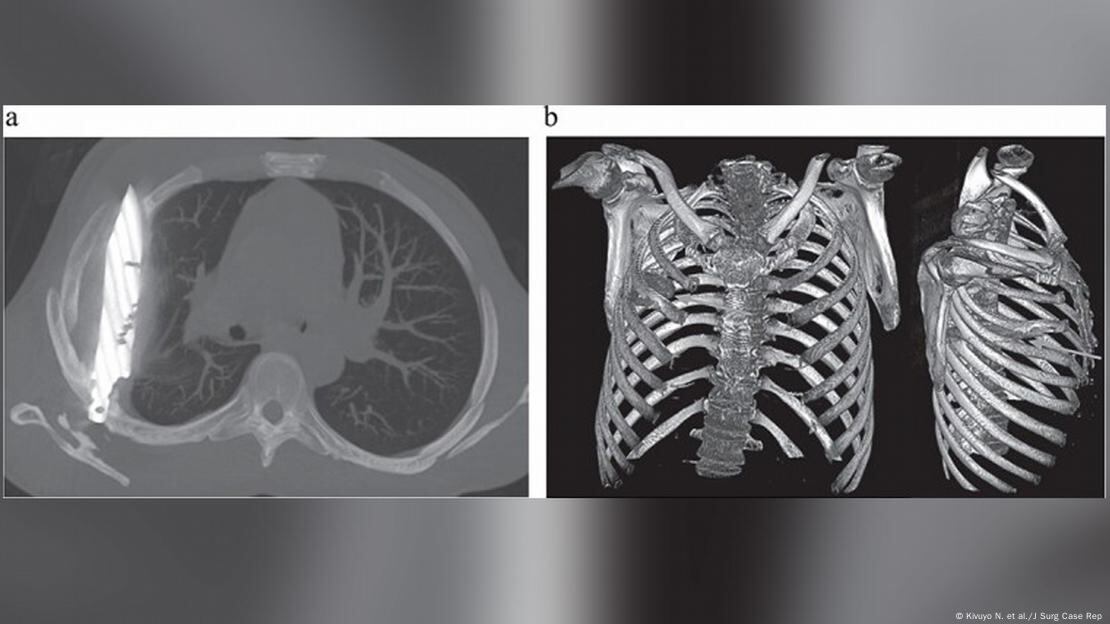 La ciencia documentó un hallazgo sorprendente: un hombre llevó un arma blanca en su cuerpo durante ocho años.
