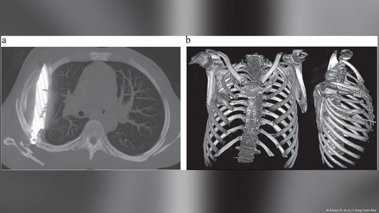 La ciencia documentó un hallazgo sorprendente: un hombre llevó un arma blanca en su cuerpo durante ocho años.