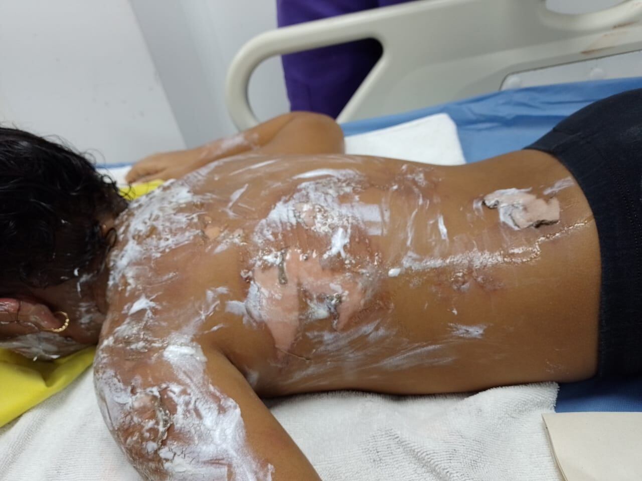 La menor fue diagnosticada con quemaduras de segundo grado.