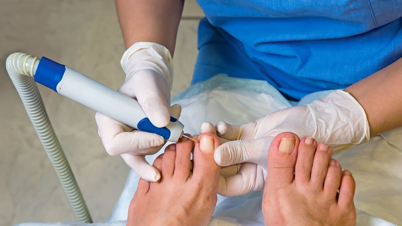 Las personas con diabetes son más propensas a tener las uñas encarnadas.