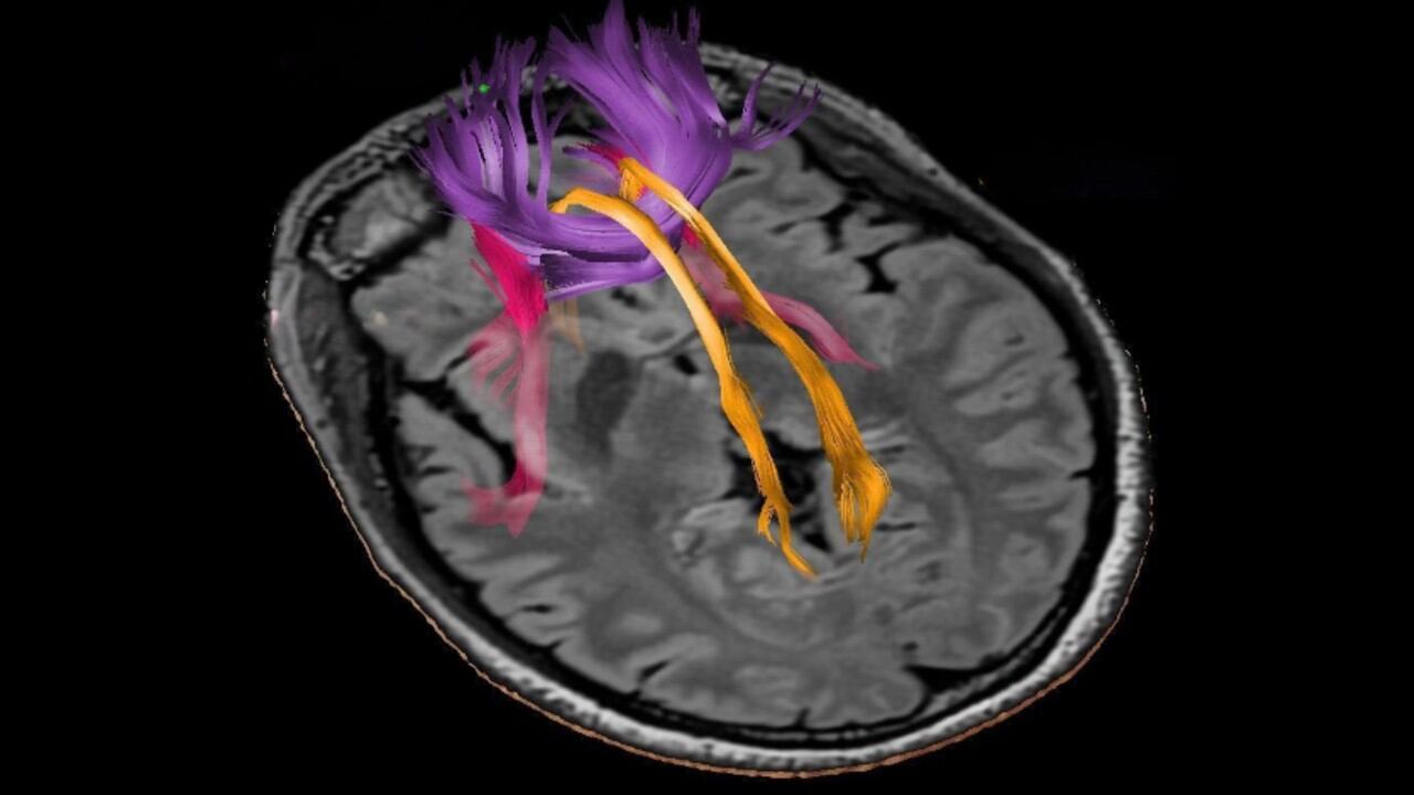 Tractografía por difusión (DTI) superpuesta a RM cerebral que muestra vías fronto-límbicas y estriato-corticales.