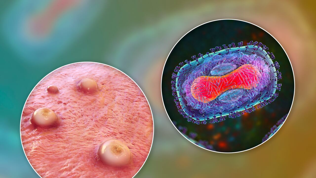 Viruela símica en Colombia