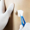 Los bultos en la piel normalmente son benignos.