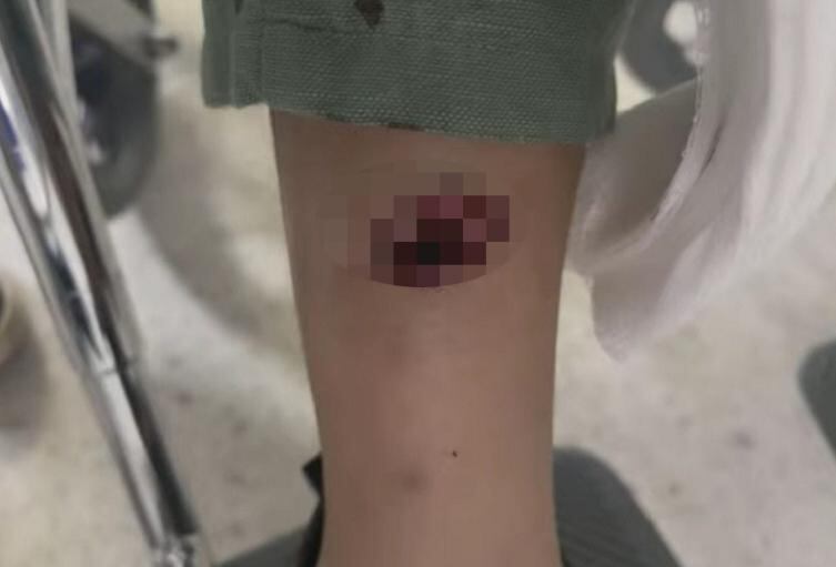 La bala afectó la pierna derecha de la niña.