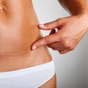 Closeup of woman belly with a scar from a cesarean section