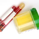 Si el cuerpo produce demasiado ácido úrico o si no logra eliminar cantidades suficientes, es posible que se acumule en el organismo formando cristales o cálculos en los riñones.