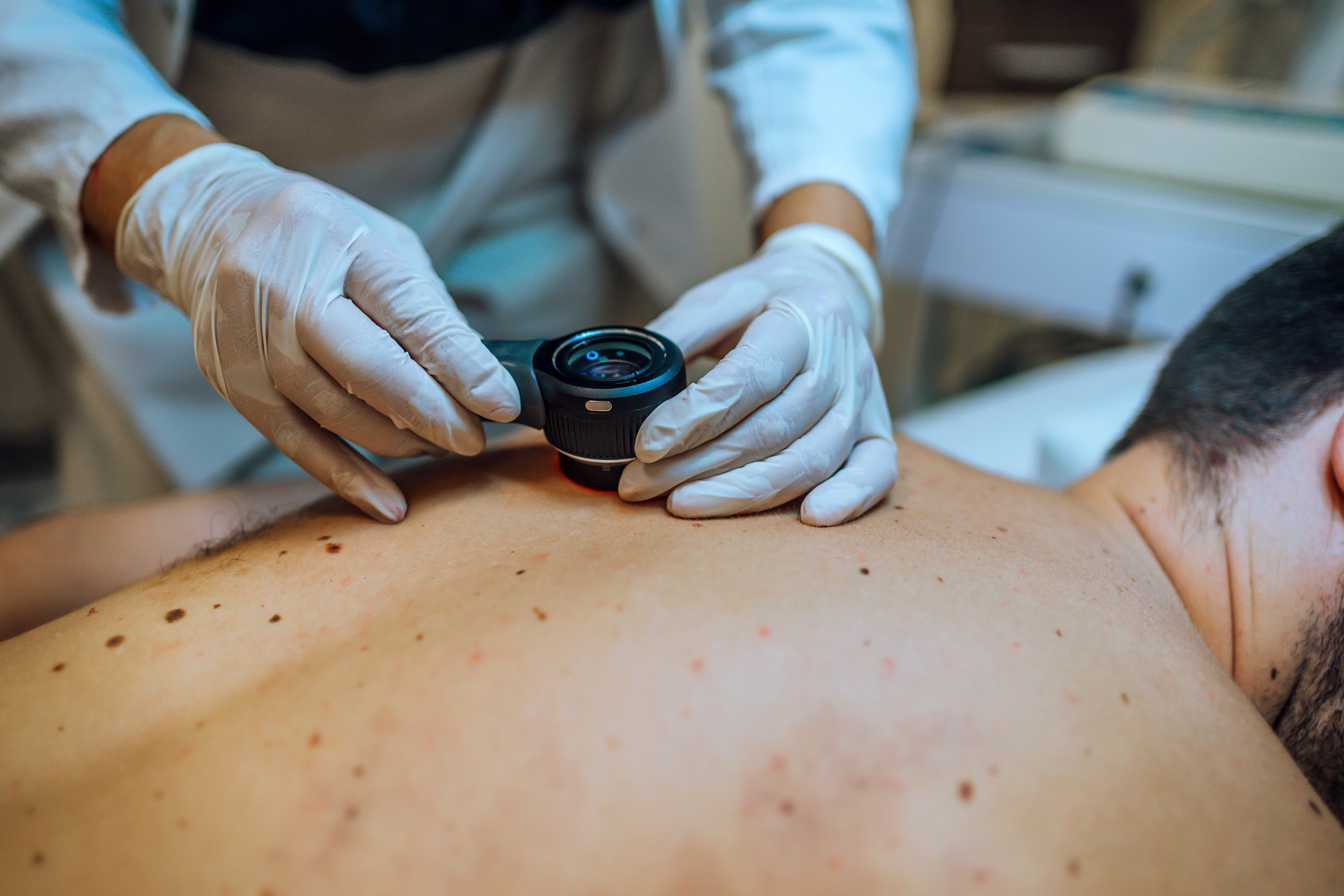 Los rayos del sol son uno de los principales factores por los que se puede desarrollar el cáncer de piel.