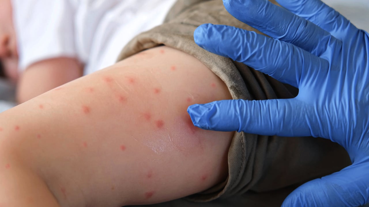 Autoridades sanitarias han elevado una alerta Nivel 2 para prevenir a quienes se dirigen a esta isla de Caribe