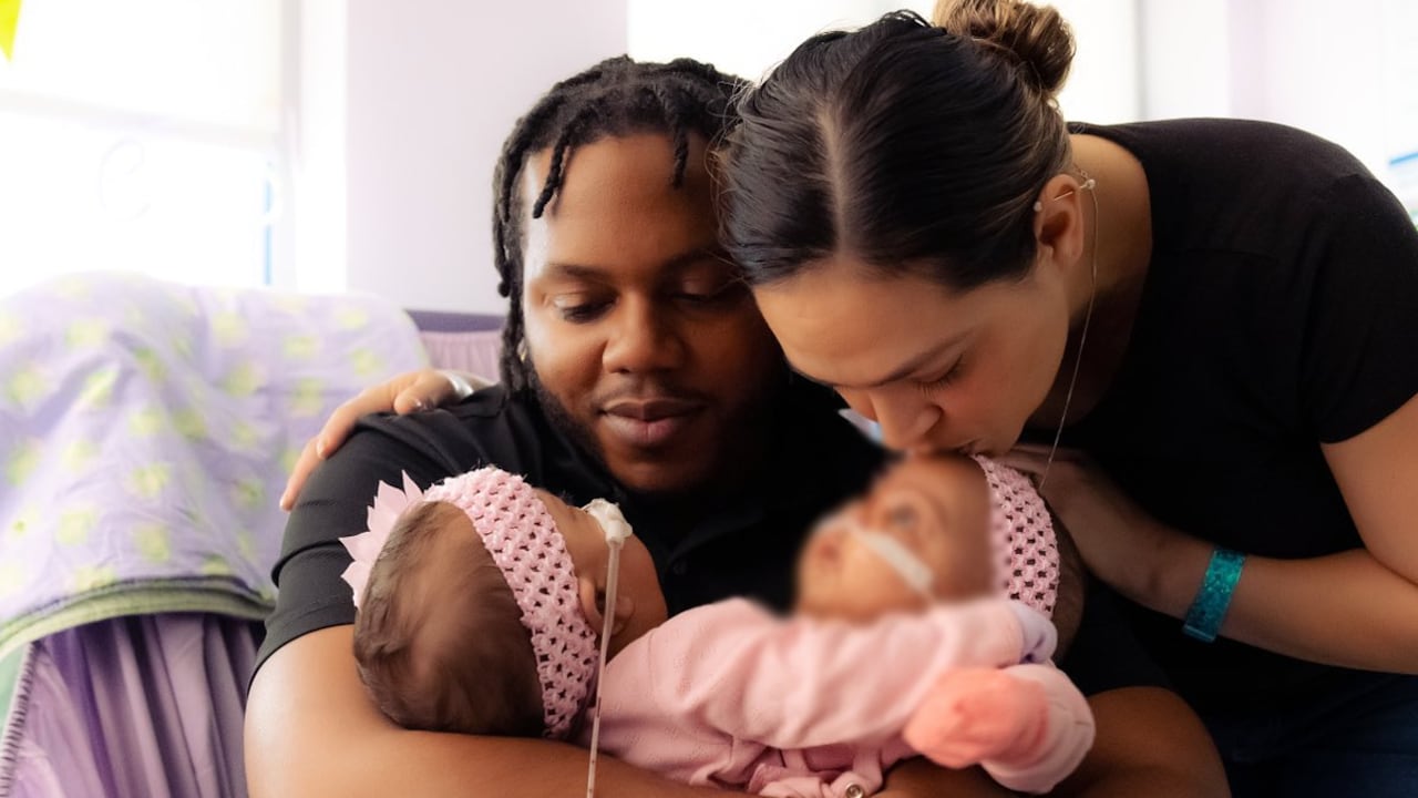 Amie Lynn y Jamie Lynn Finley, junto a sus padres. La cirugía para separarlas fue un éxito.