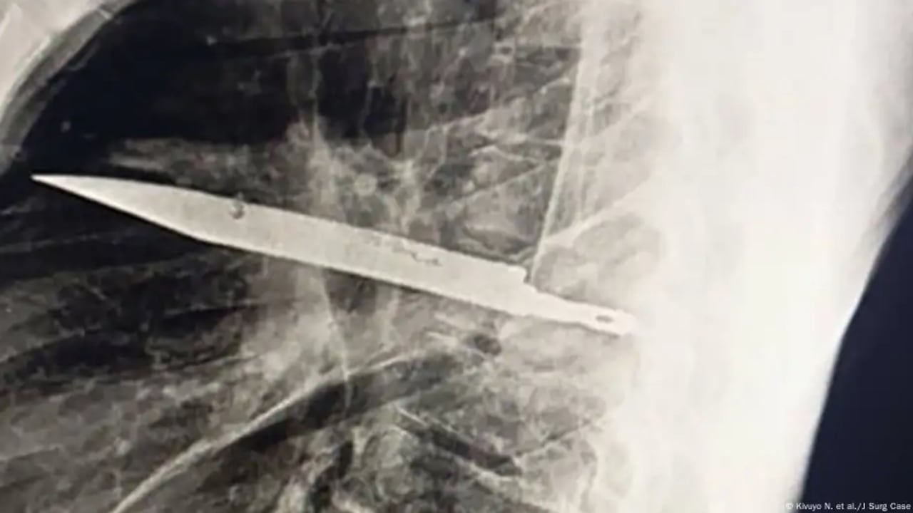 Una consulta médica destapó un caso extraordinario: un hombre tenía una hoja de cuchillo alojada en el tórax.