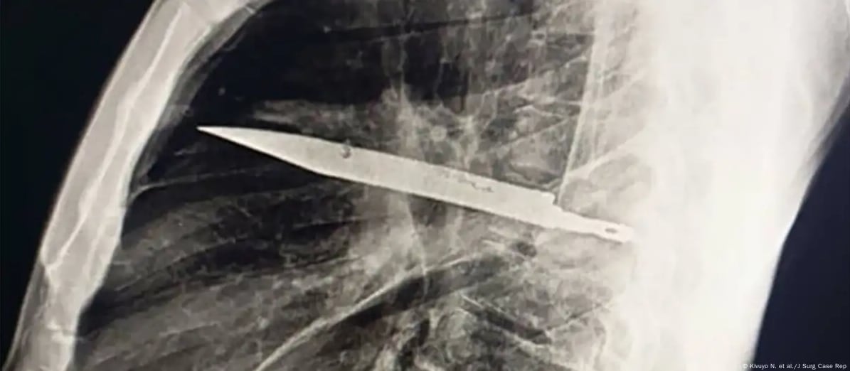 Una consulta médica destapó un caso extraordinario: un hombre tenía una hoja de cuchillo alojada en el tórax.