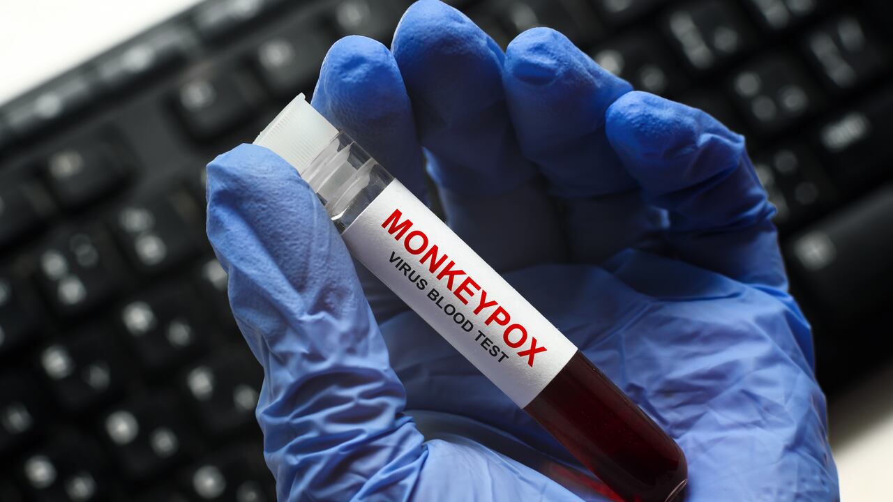 Nuevo contagio por viruela símica en Ibagué, la ciudad llega a los 58 pacientes infectados