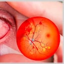 retinopatía diabética