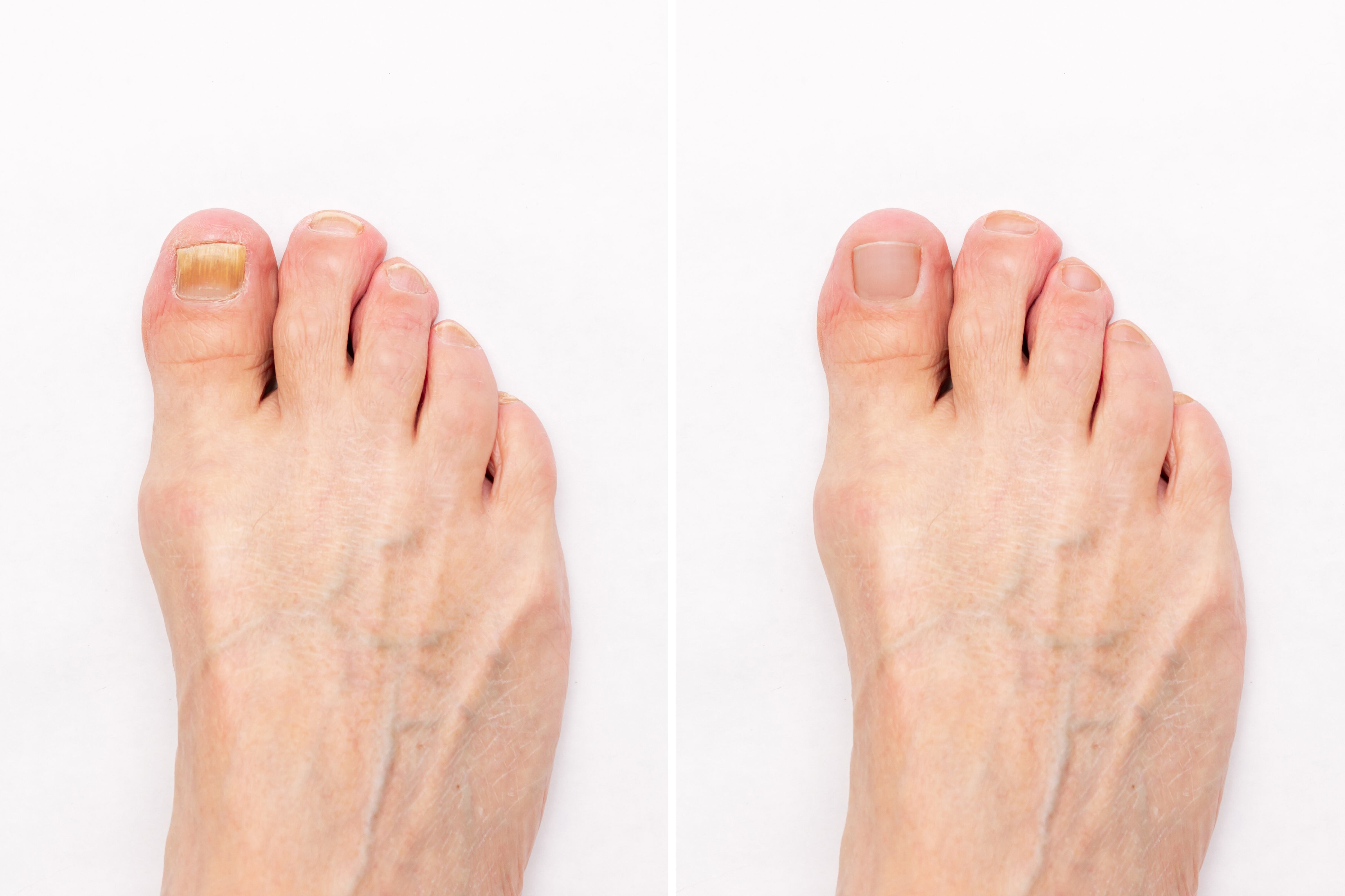 Diferentes remedios caseros pueden ser una gran opción para combatir los hongos en las uñas.