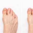 Diferentes remedios caseros pueden ser una gran opción para combatir los hongos en las uñas.