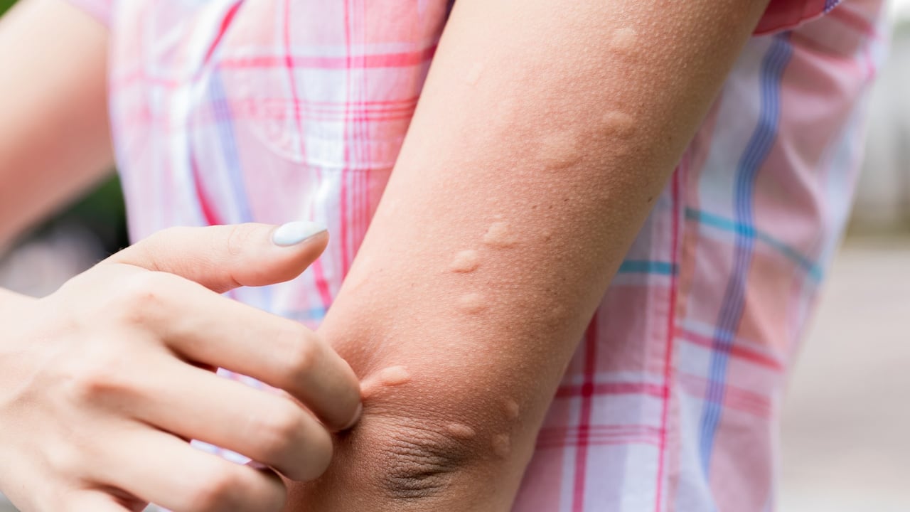 Una de las mejores formas de aliviar la picazón una vez ya nos han picado el mosquitos es aplicando el bicarbonato de sodio sobre la herida.