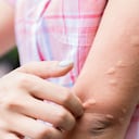 Una de las mejores formas de aliviar la picazón una vez ya nos han picado el mosquitos es aplicando el bicarbonato de sodio sobre la herida.