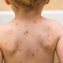 La varicela normalmente es menos fuerte en los niños que en los adultos.